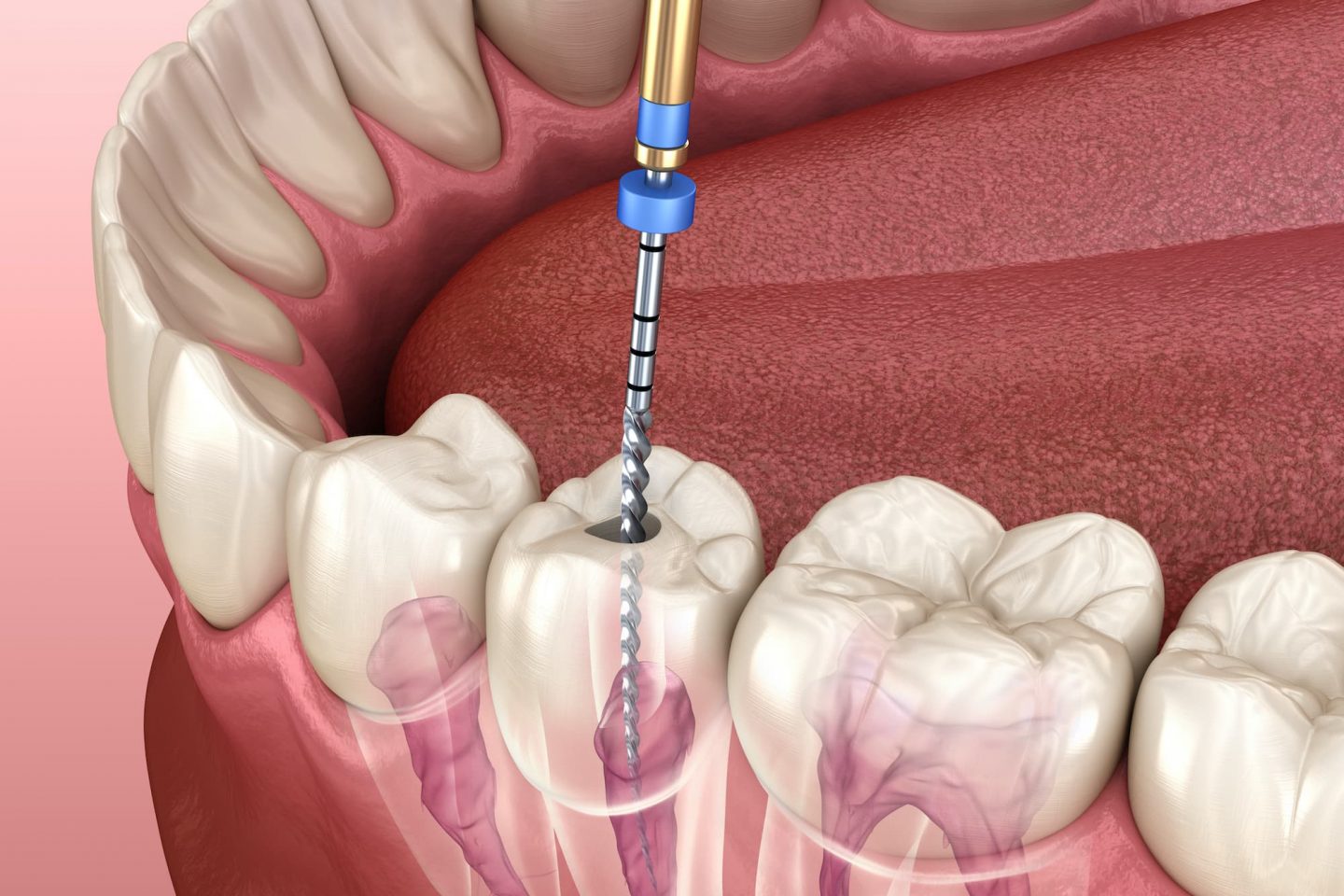 Mastering Minimally Invasive Root Canal Cleaning: Precision in Access & Canal Navigation